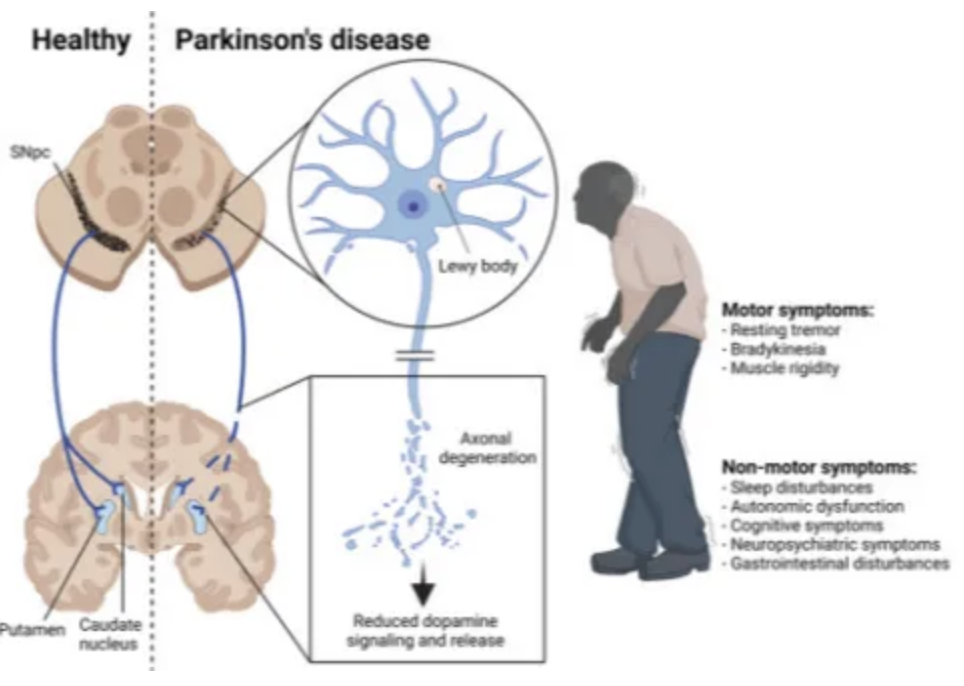 World Parkinson's Day | Pathogenesis of Parkinson's Disease and Related Animal Models