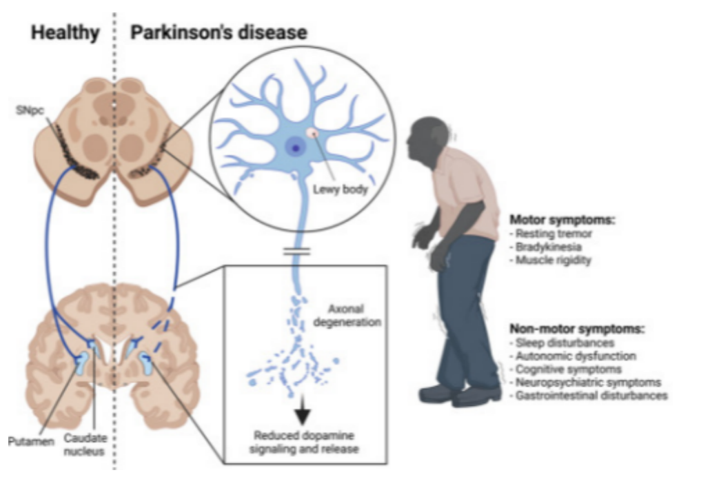 World Parkinson's Day | Comprehensive Analysis of Parkinson's Disease Pathogenesis and Genetically Engineered Mouse Models